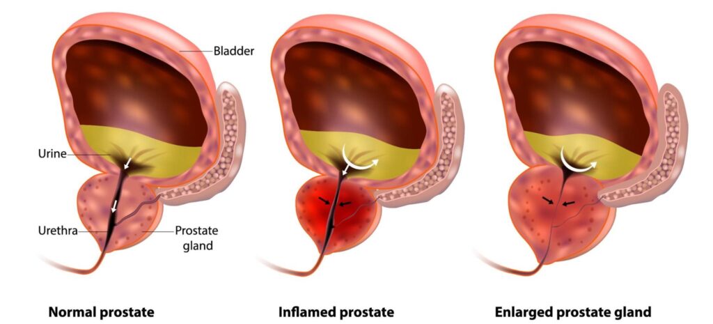 Ten Worst Foods for Prostate Health